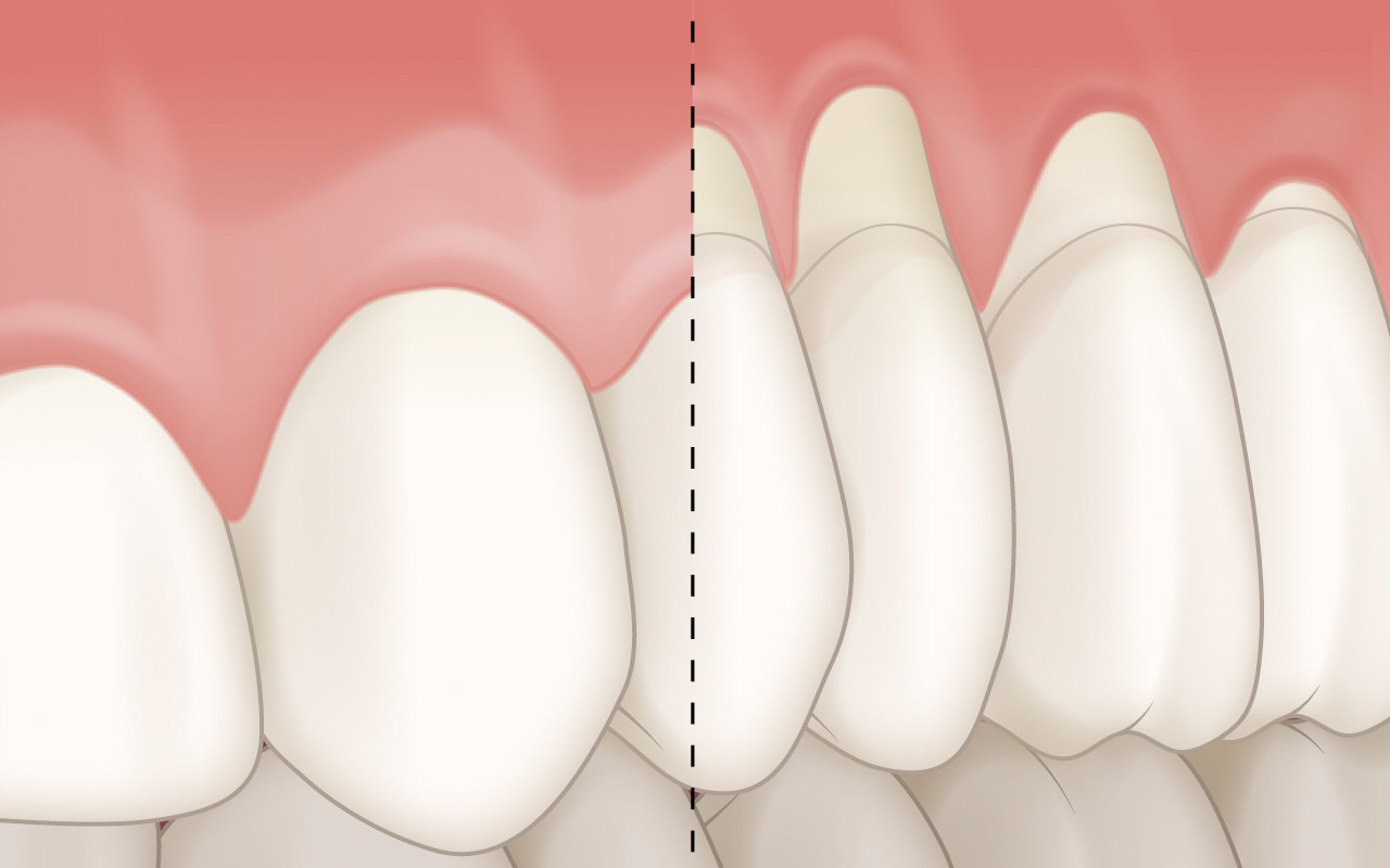 Was ist eine Zahnfleischrezession?