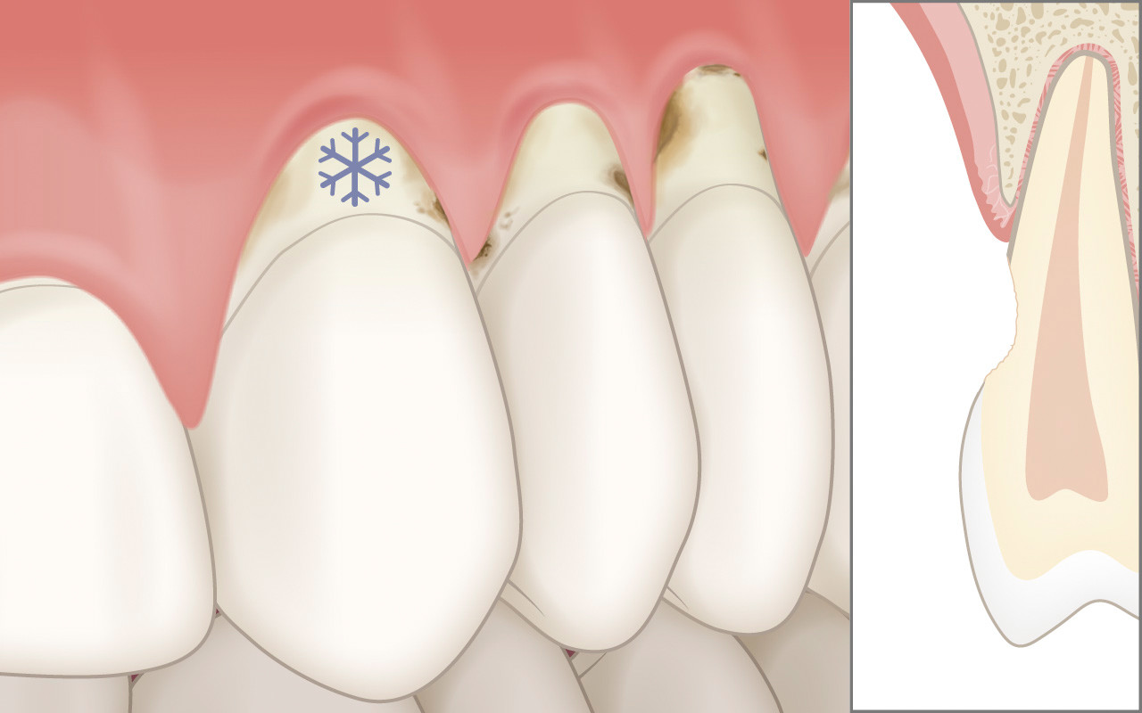 Folgen der Zahnfleischrezession