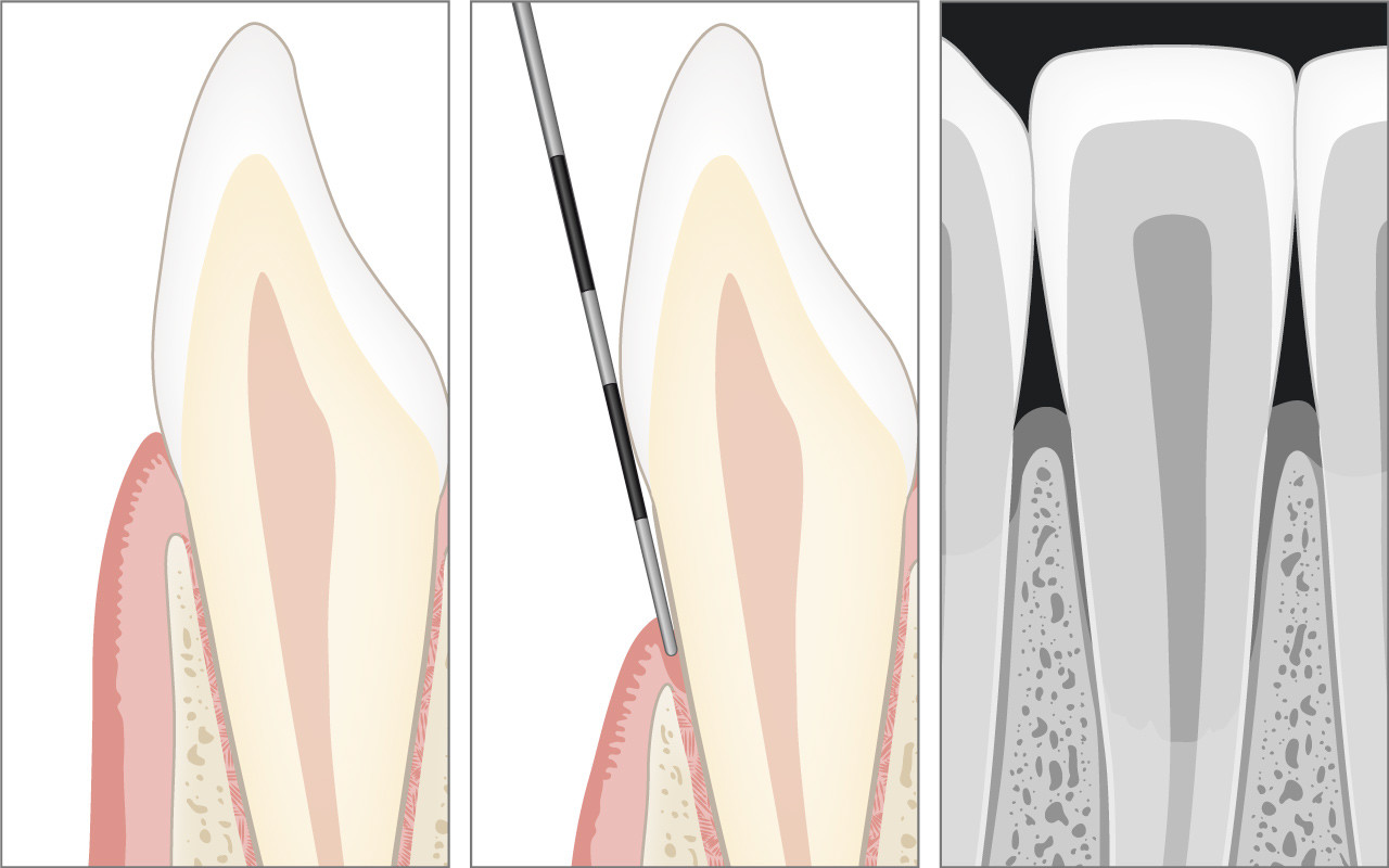 Diagnose der Zahnfleischrezession