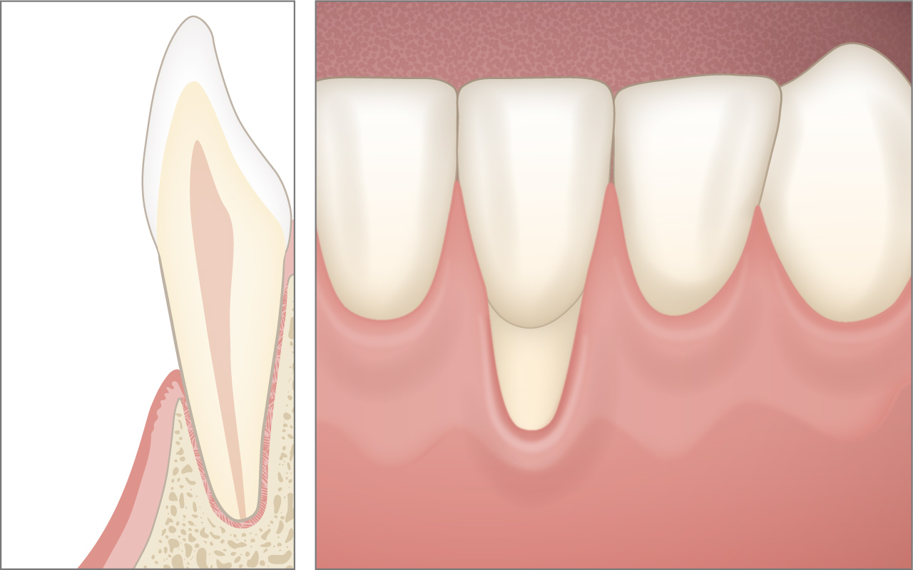 Was ist eine Zahnfleischrezession und wie häufig kommt sie vor?