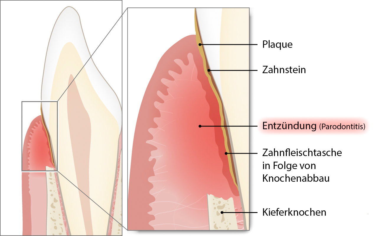 Was ist die Parodontitis und wie häufig kommt sie vor?