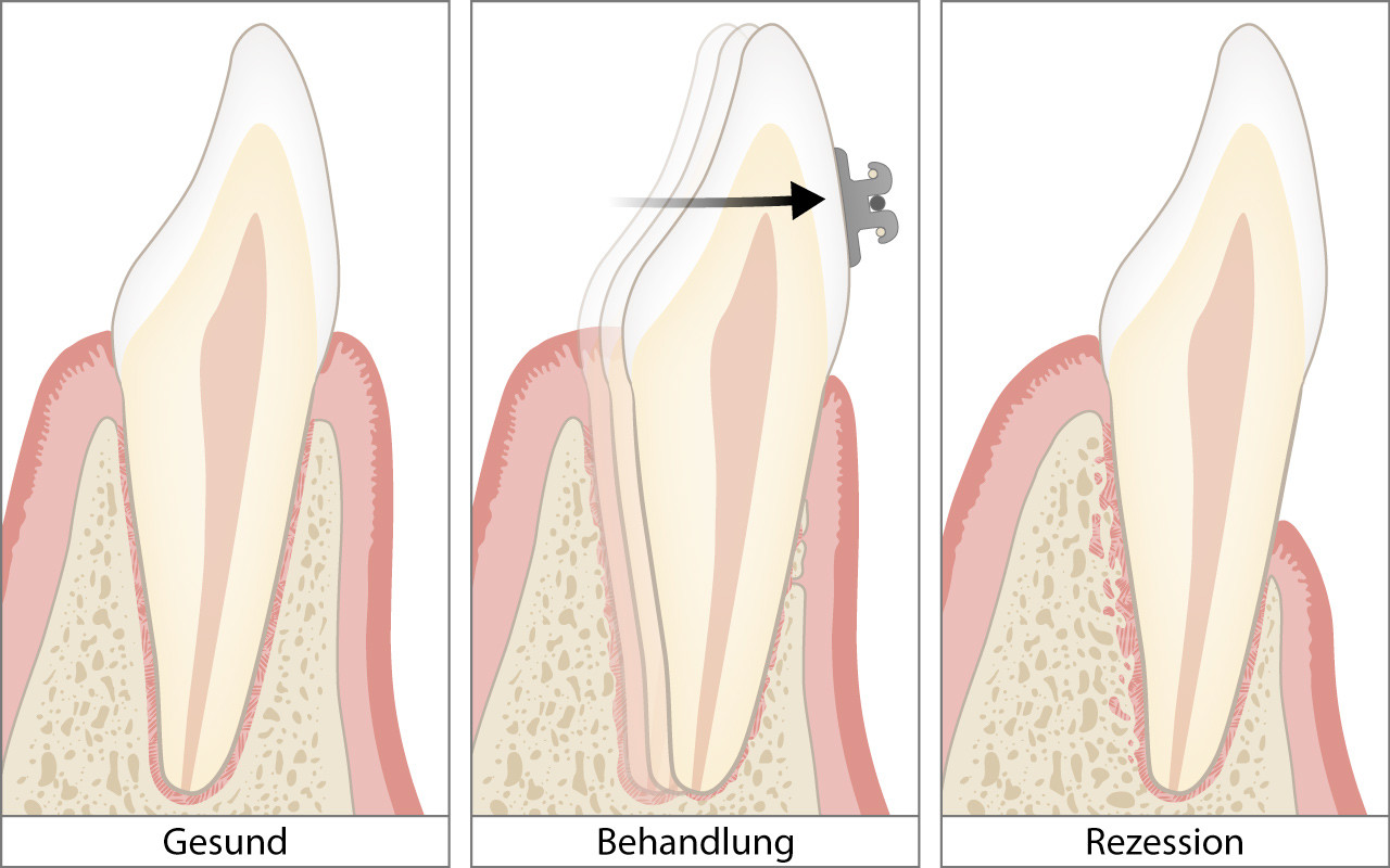Kieferorthopädische Behandlung