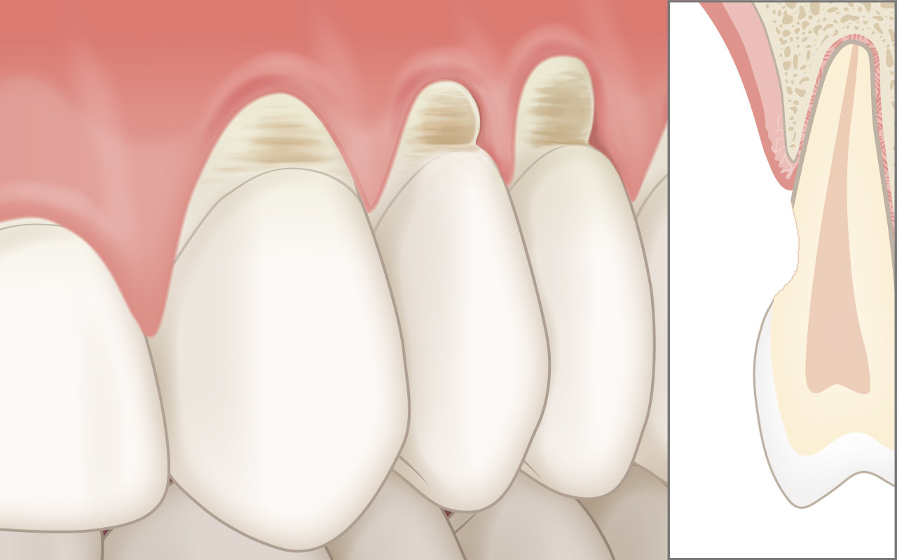 Abgetragene Zahnhälse (Abrasionen)