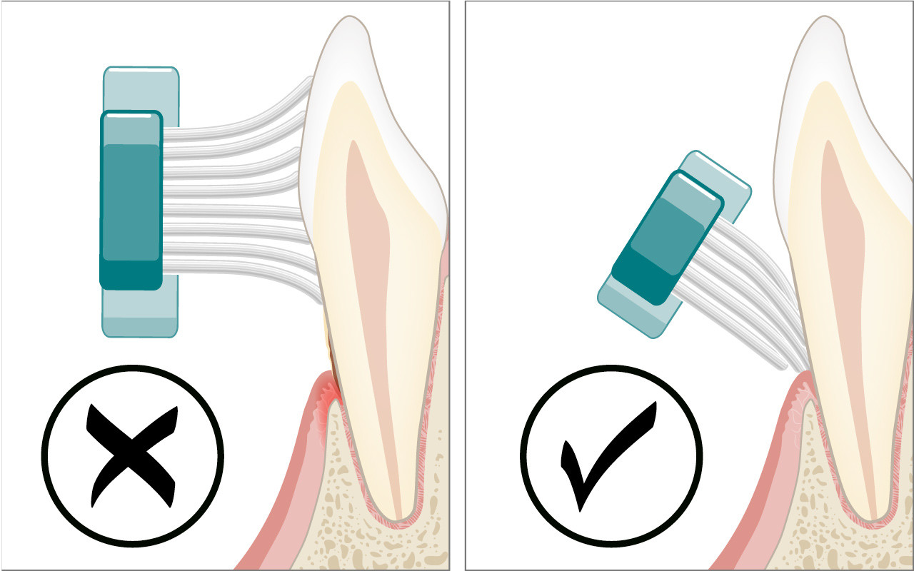 Optimierung der häuslichen Mundhygiene