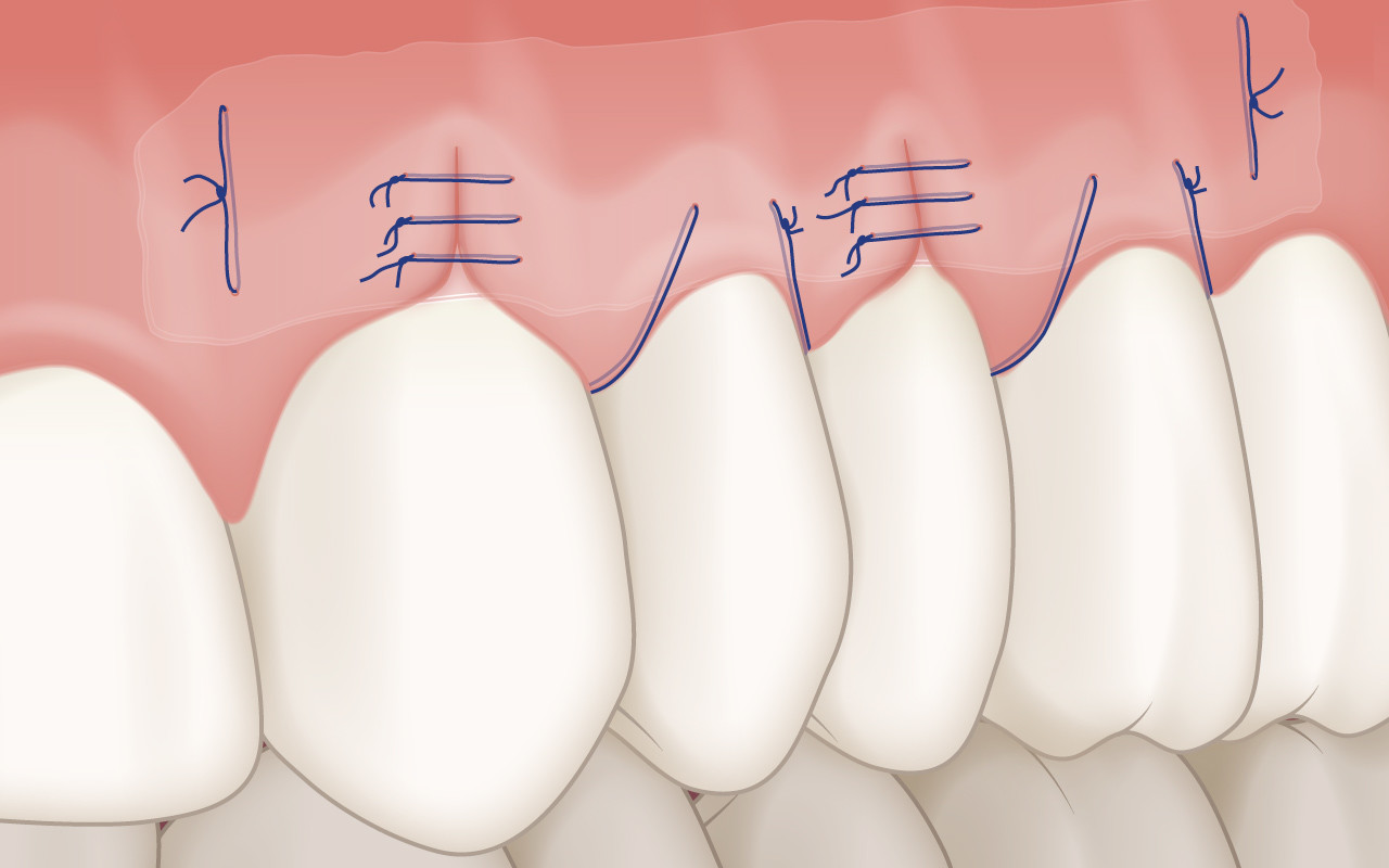 Chirurgische Weiterbehandlung