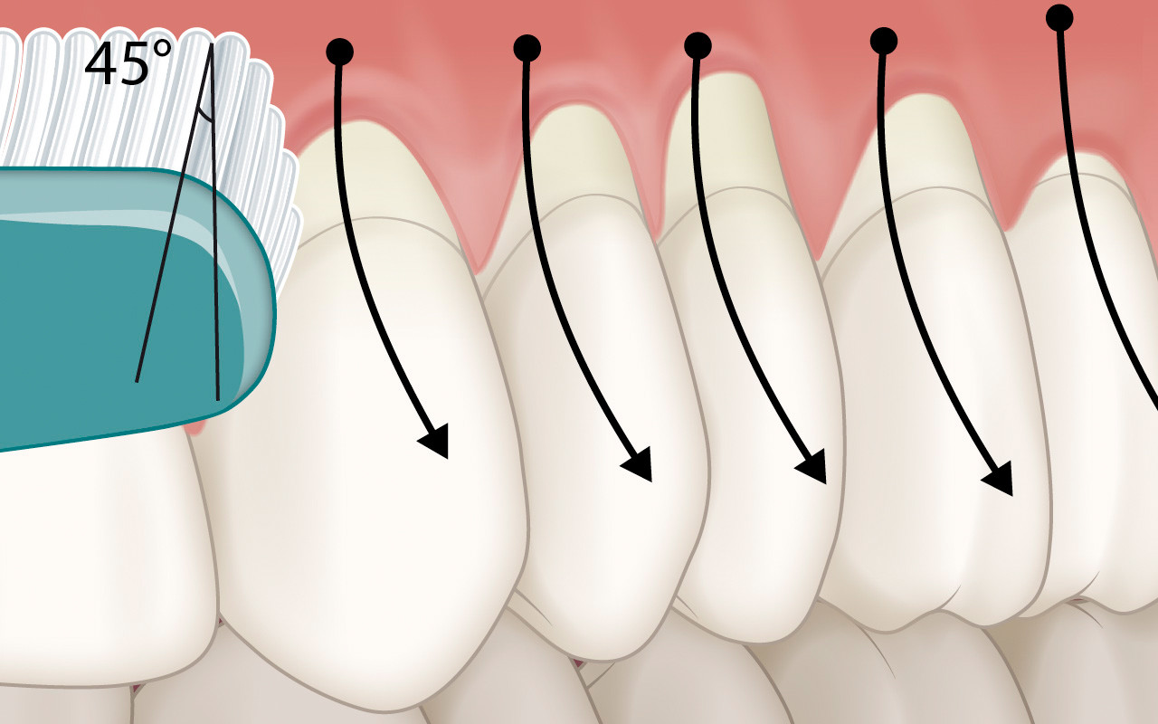 Optimierung der Mundhygiene bei vorhandenen Zahnfleischrezessionen