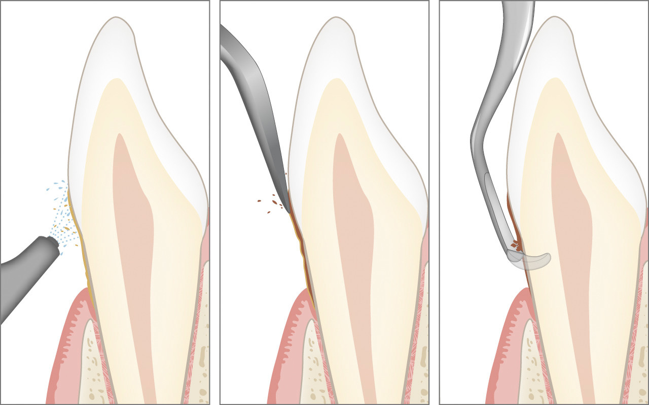 Regelmässige professionelle Zahnreinigung